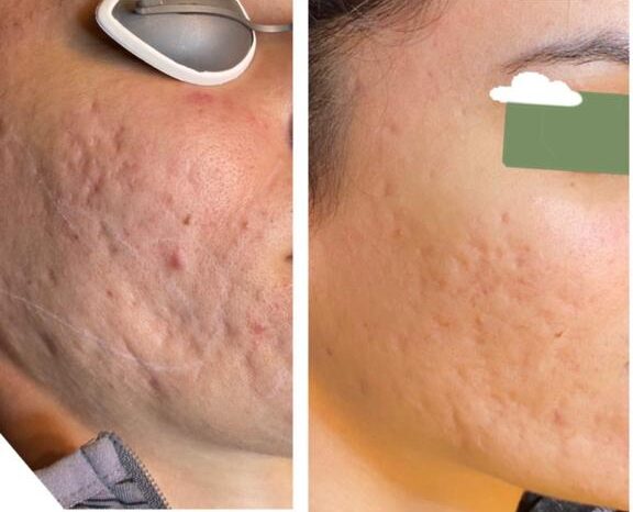Microneedling acne scars reduction