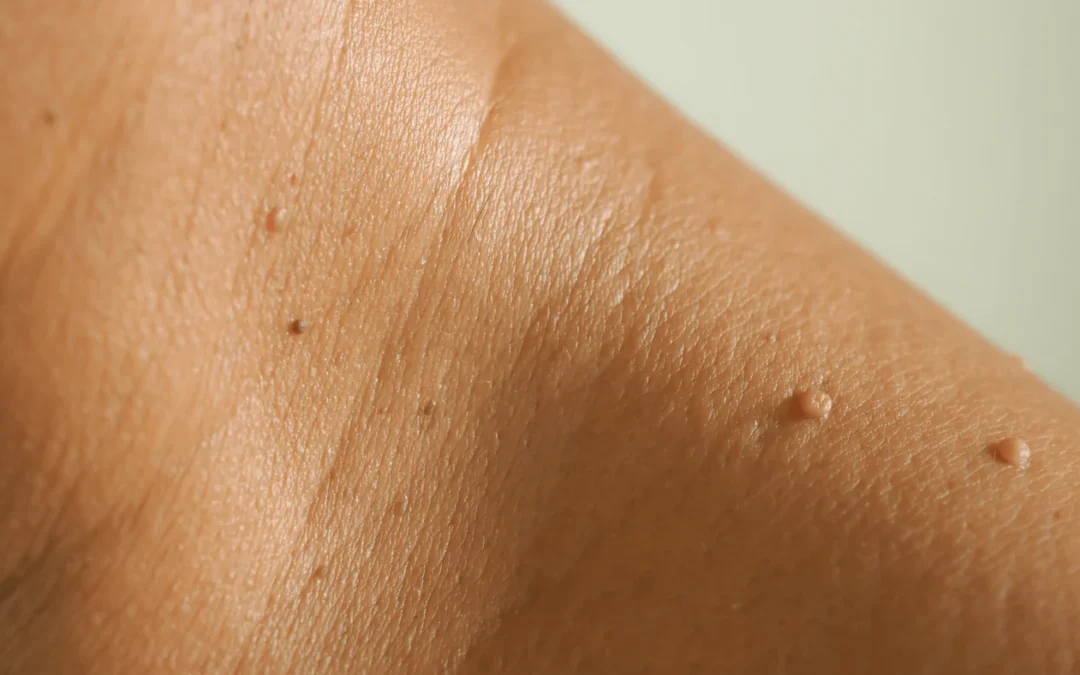 Skin Tag Removal: A Comprehensive Guide