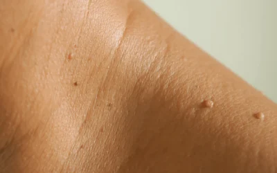 Skin Tag Removal: A Comprehensive Guide
