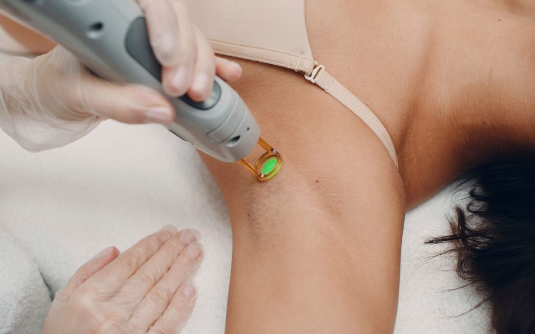 A Laser Hair Removal Results Timeline: Your Journey to Smooth Skin