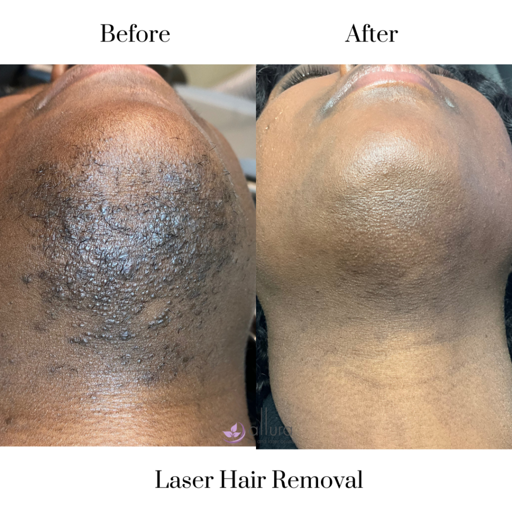 Before and after results of facial laser hair removal showing reduced chin and upper lip hair, smoother skin, and improved skin tone in a female client.
